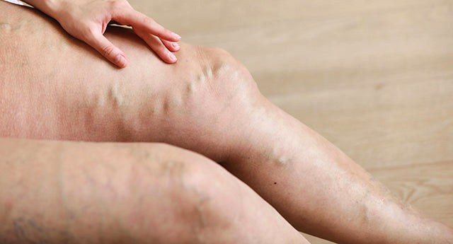 sintomas y tratamiento de varices en piernas con presoterapia